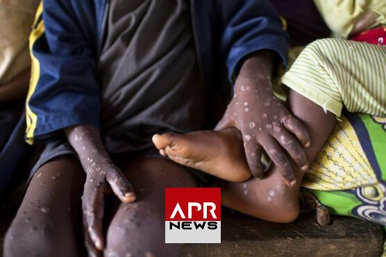 APRNEWS: Variole du singe, la Côte d’Ivoire face à une menace sanitaire