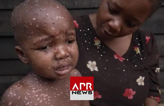 APRNEWS : Burundi – plus de 60% des moins de 19 ans touchés par le Mpox