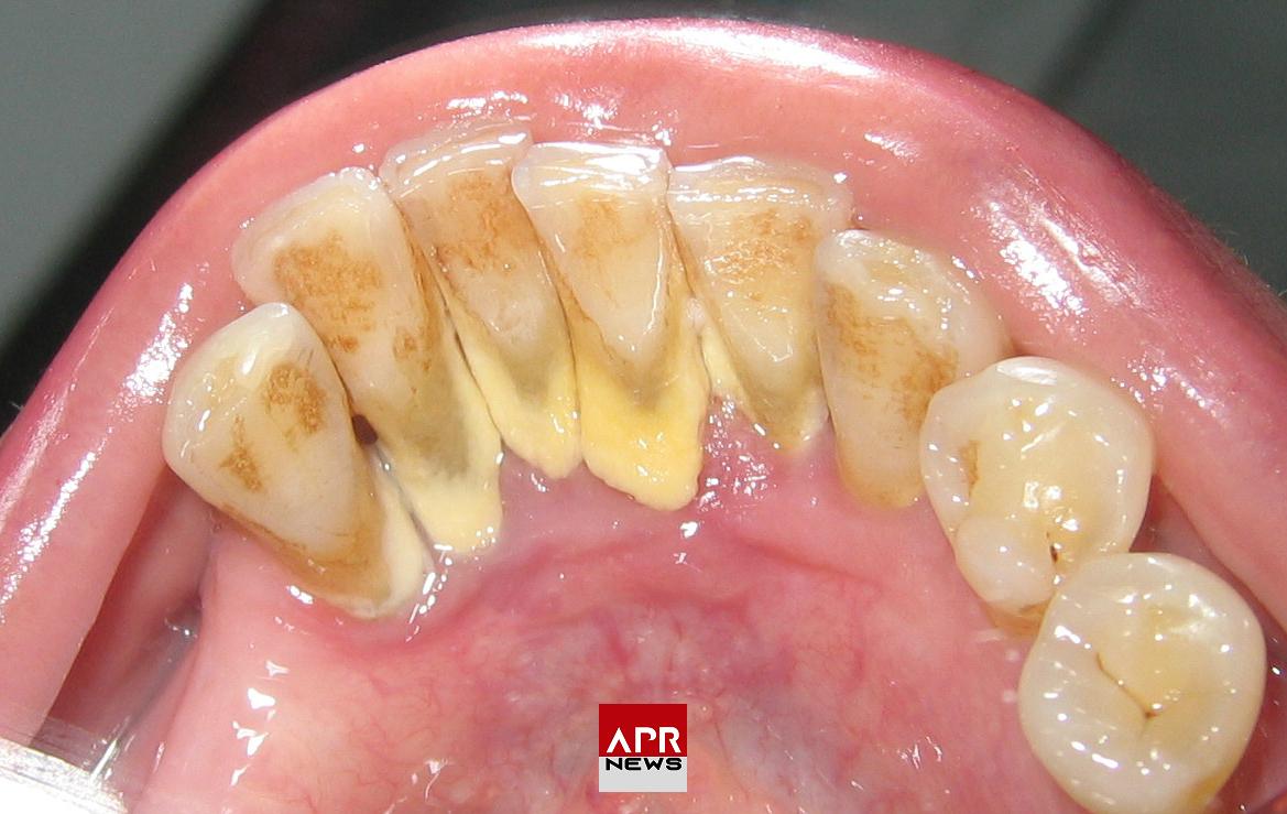 APRNEWS: Qu’est-ce qui provoque la mauvaise haleine ?