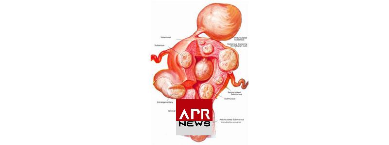APRNEWS: Fibrome utérin APRNEWS: Fibrome utérin
