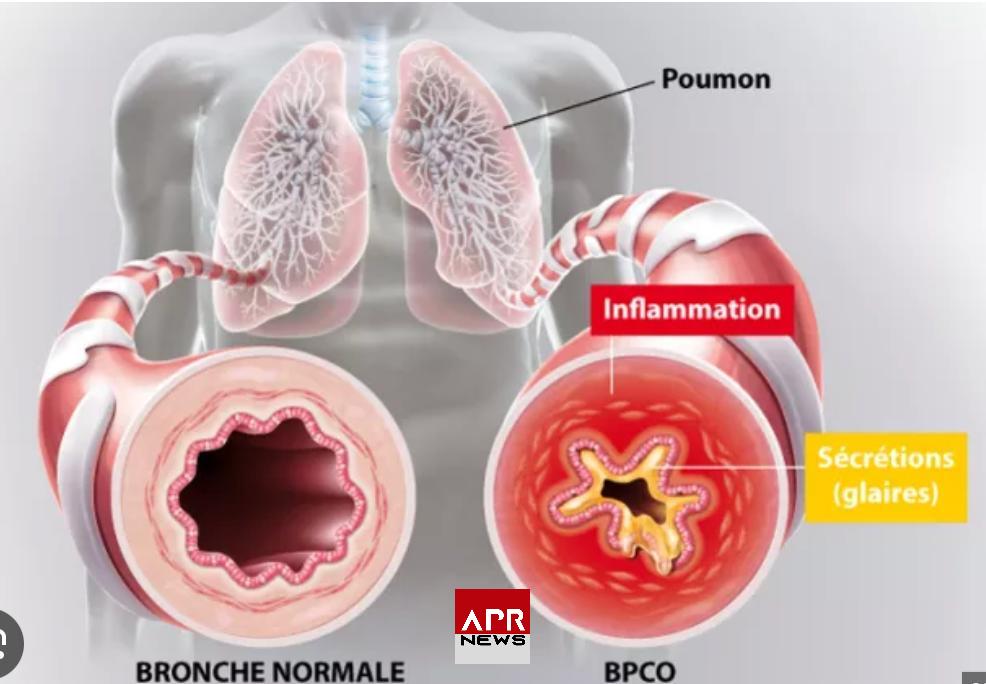 APRNEWS: La BPCO signifie bronchopneumopathie chronique obstructive