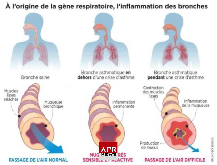 APRNEWS: Bronchite asthmatiforme – Comprendre sa durée et son évolution APRNEWS: Bronchite asthmatiforme – Comprendre sa durée et son évolution