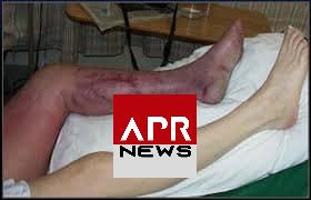 APRNEWS: Ischémie APRNEWS: Ischémie