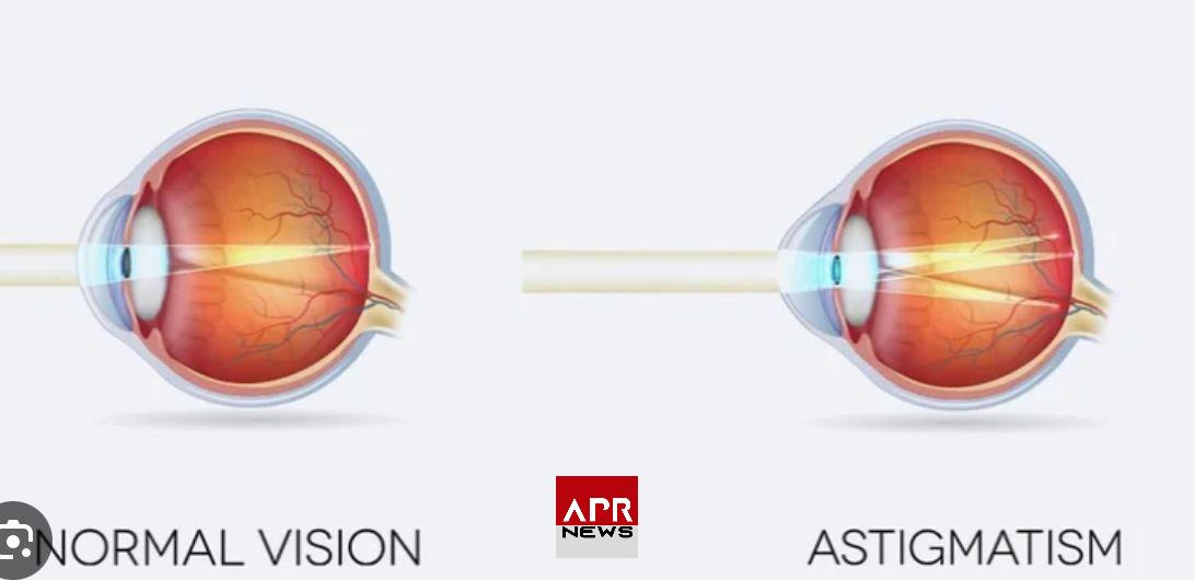 APRNEWS: Astigmatisme – Symptômes et traitements