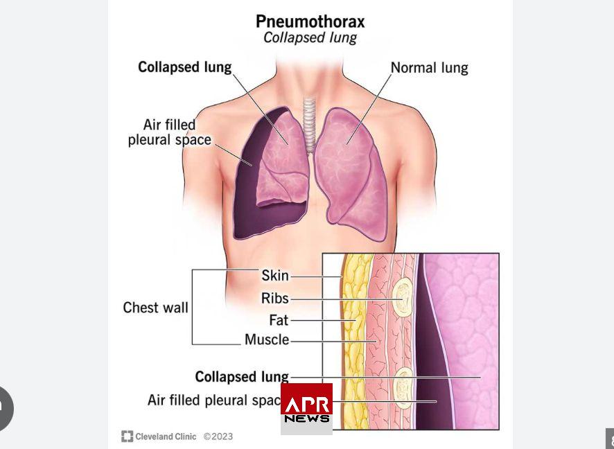 APRNEWS: Pneumothorax