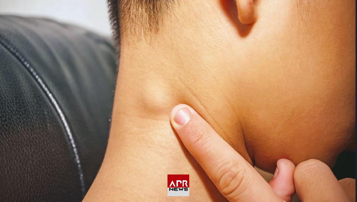 APRNEWS: Ganglion dans le cou